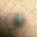 Dermatofibroma