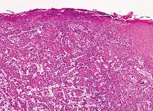 Moderately differentiated lesions of invasive SCC show much less organization and maturation with significantly less keratin formation.