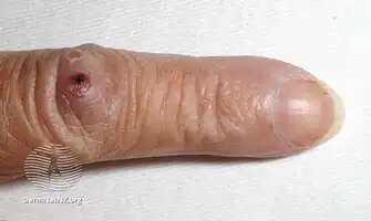 Osler nodes on index finger