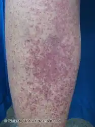 Petechiae due to thrombocytopenia