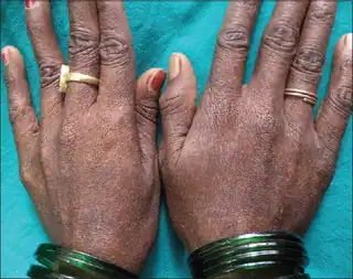 Freckle-like marks on back of hands