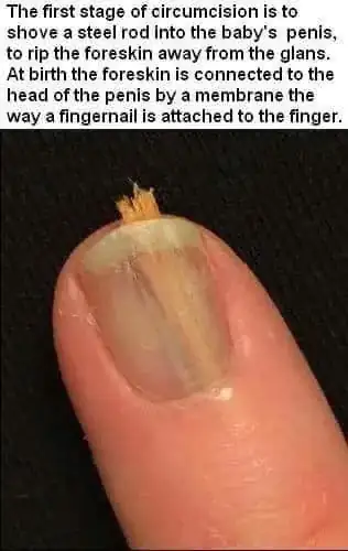 wood splinter under nail