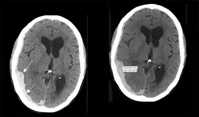white arrows are pointing to the hematoma