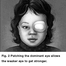 Medical diagram of patched eye